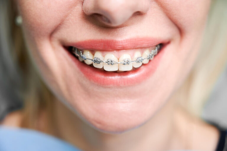 adult smile with braces