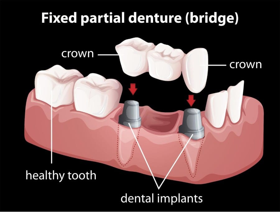 Dental implants Advantages and disadvantages Somos Dental Mesa