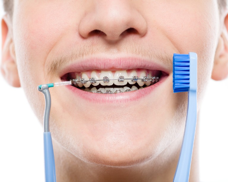 Tips for Brushing Your Teeth with Braces Somos Dental Mesa