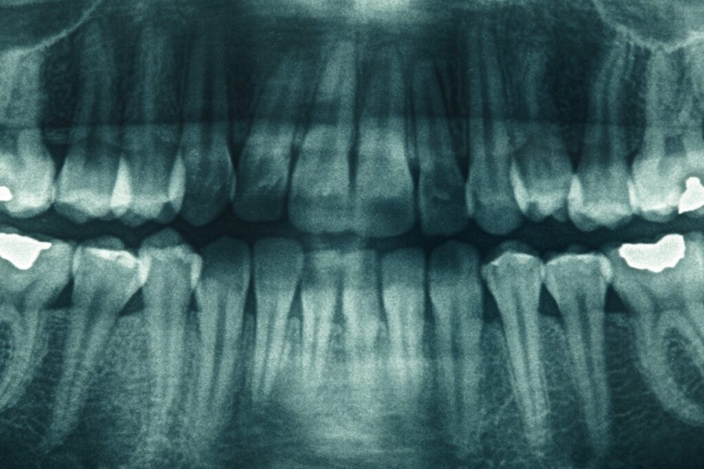 Everything about dental Xrays Somos Dental